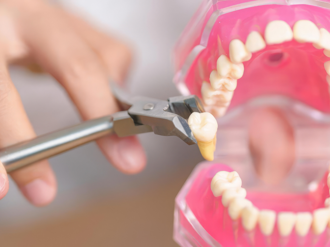 Diagram comparing simple and surgical tooth extraction methods offered in Louisville, KY