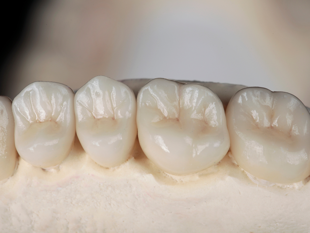 Dental model illustrating dental crown and bridge treatment for patients in Louisville, KY