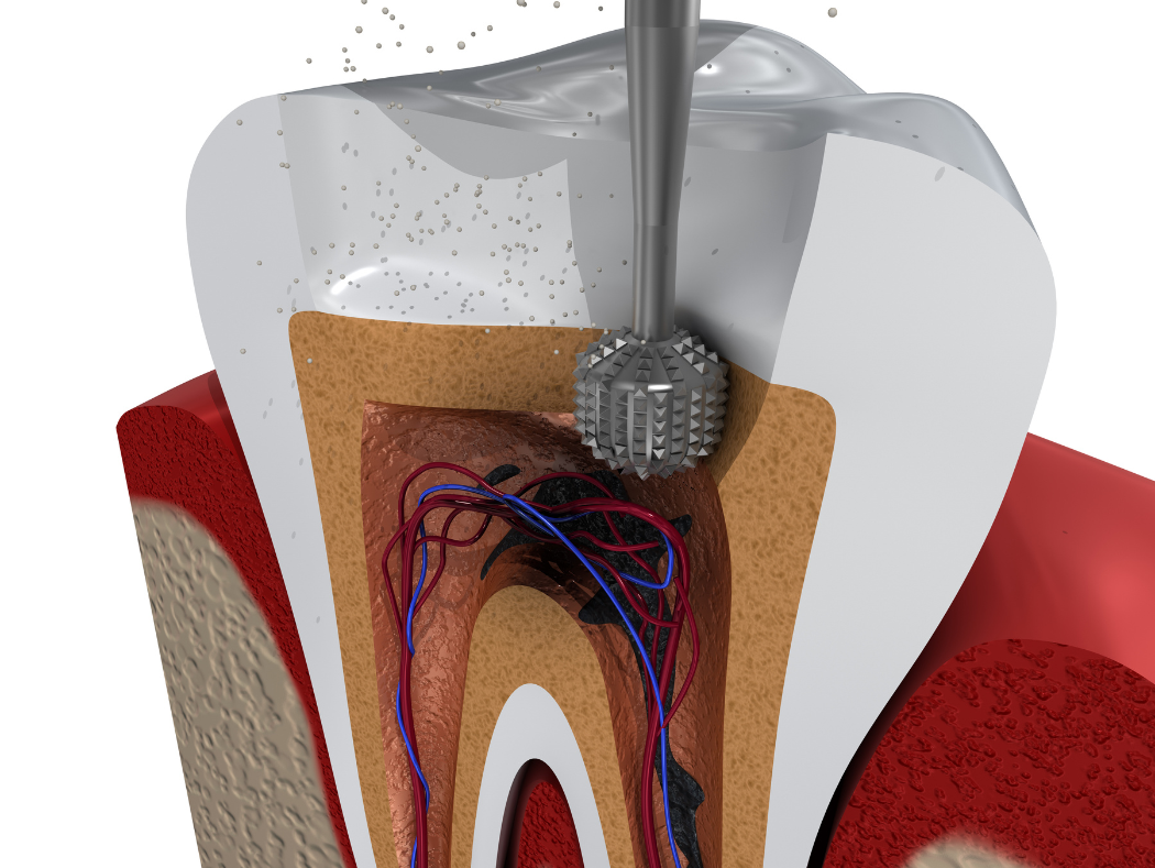 Dental model illustrating root canal treatment for patients in Louisville, KY
