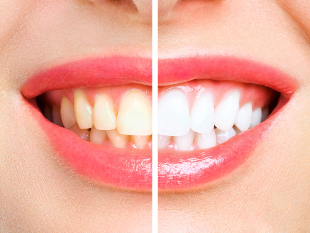 Patient with a bright, white smile after professional teeth whitening in Louisville, KY
