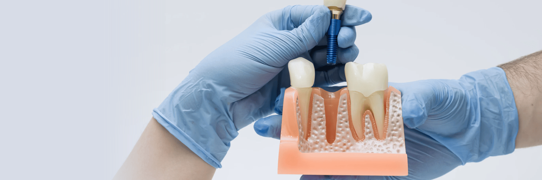 Close-up of a second dental implant model used to explain tooth replacement options in Louisville, KY