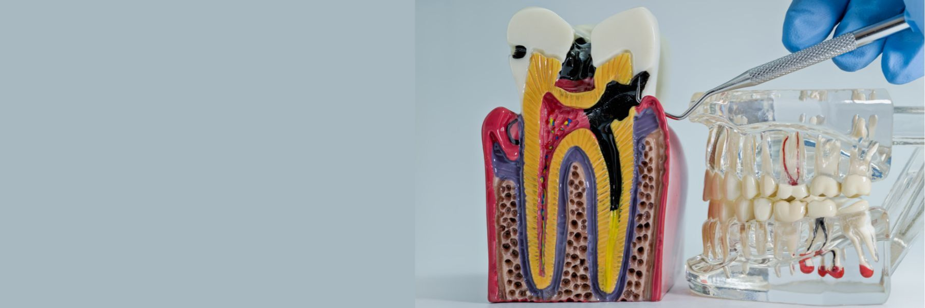 A detailed dental model illustrating root canal treatment for patients in Louisville, KY