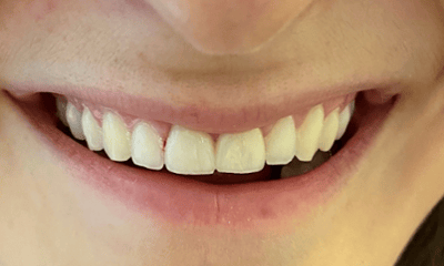After photo of a patient's smile following ceramic crown treatment in Louisville, KY