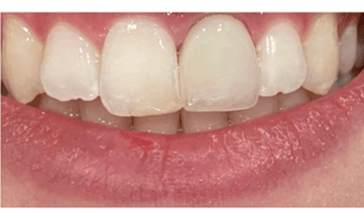 After photo of a patient's smile following crown replacement treatment in Louisville, KY