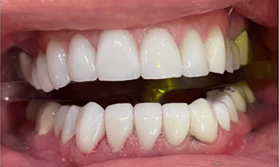After treatment - Smile Makeover