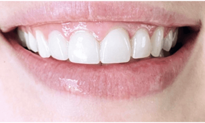 After treatment - Veneers