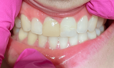 Before photo of a patient's smile prior to ceramic crown treatment in Louisville, KY