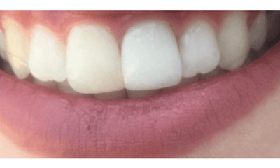 Before photo of a patient's smile prior to crown replacement treatment in Louisville, KY