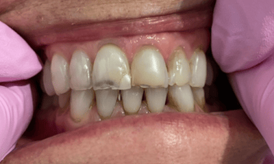 Before treatment - Smile Makeover