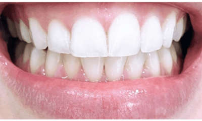 Before treatment - Veneers