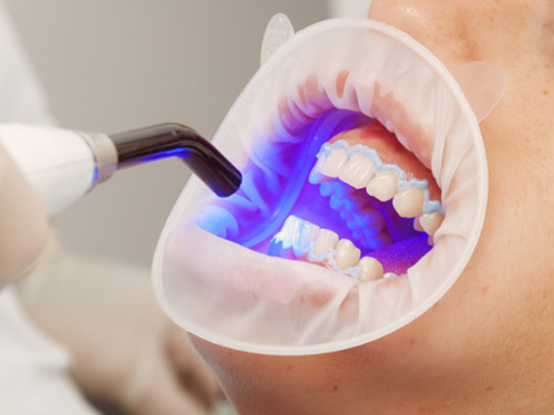 Laser Whitening