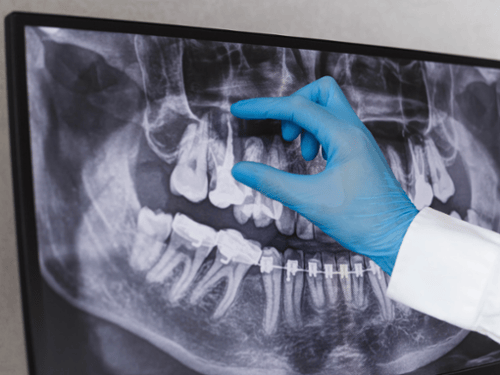 Panoramic X-Ray